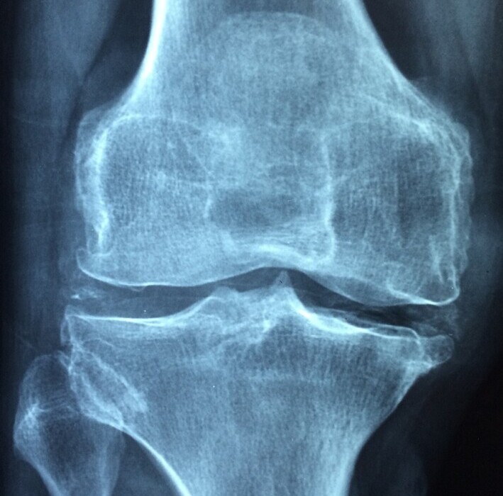 Arthritis - The Organic Houses